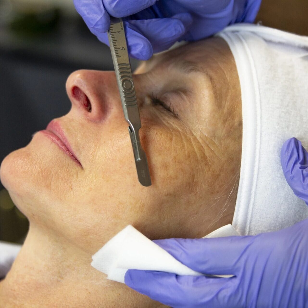 cp-dental-dermaplaning