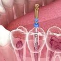 cp-dental-root-canal